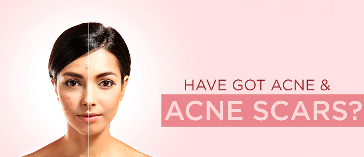 Have Got Acne & Acne Scars? (The Guide Has the Best Solution)